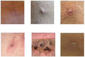 Six close up images of monkeypox blisters in varying stages of development from first infection to scabbing over.